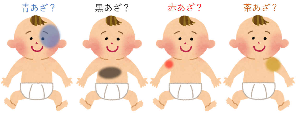異所性蒙古斑や太田母斑 異所性蒙古斑や太田母斑