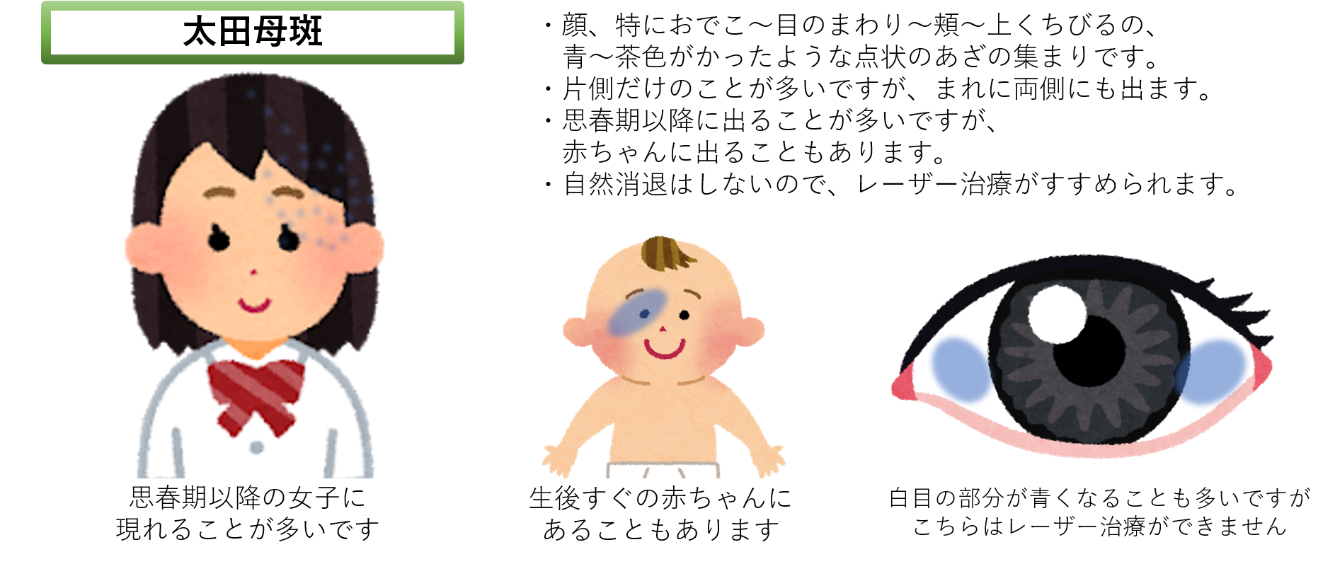 太田母斑 太田母斑