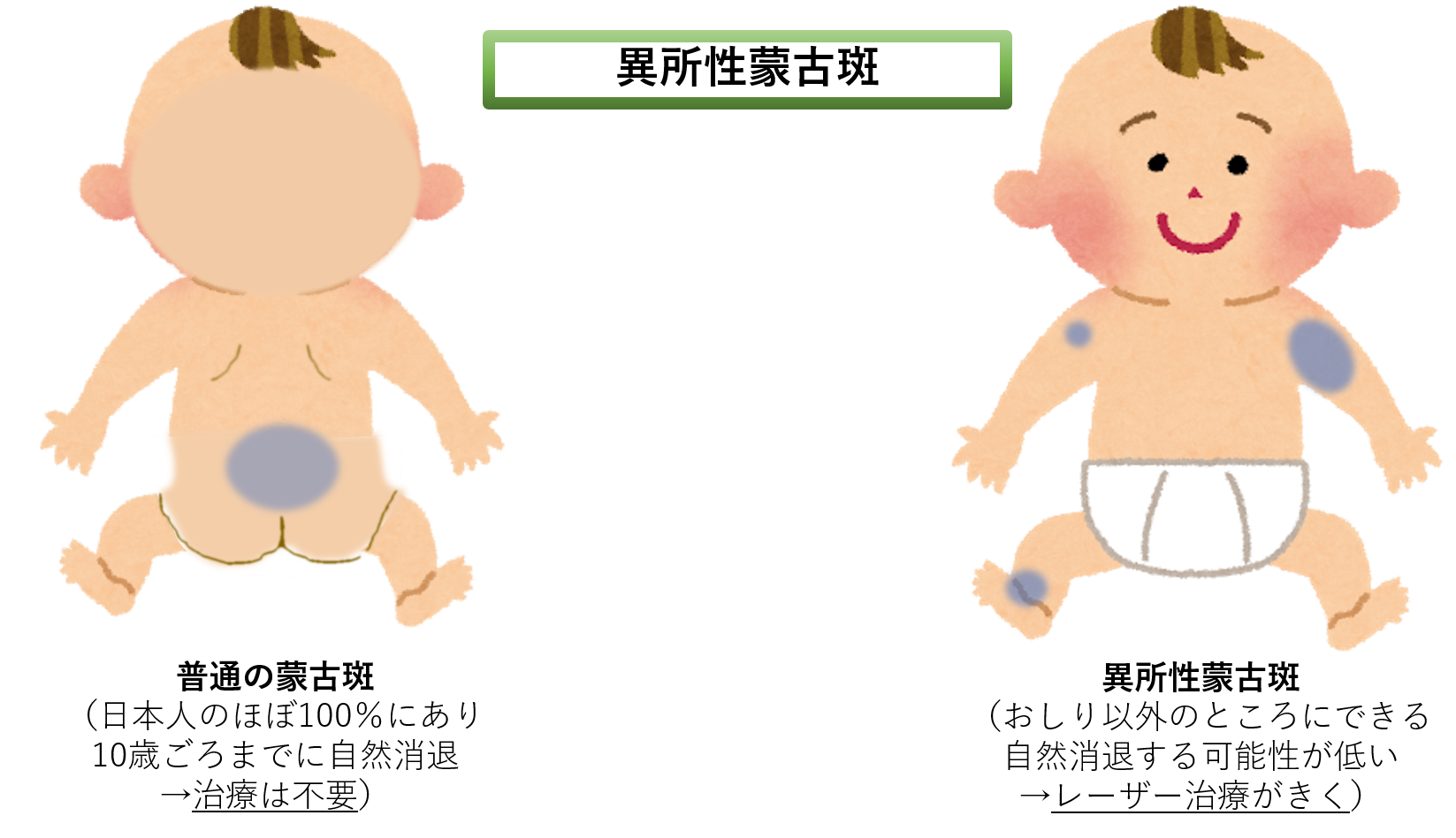 異所色性蒙古斑 異所色性蒙古斑