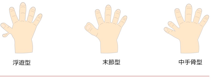 多指症(多趾症) 多指症(多趾症)