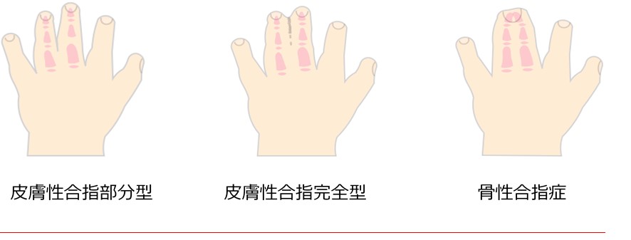 合指症(合趾症) 合指症(合趾症)