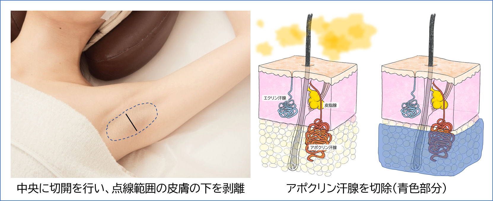 ワキガの手術 ワキガの手術