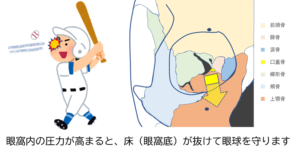 眼窩底骨折1 眼窩底骨折1