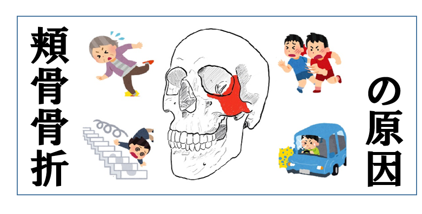 鼻骨骨折とは 鼻骨骨折とは