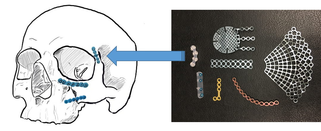 鼻骨骨折手術 鼻骨骨折手術