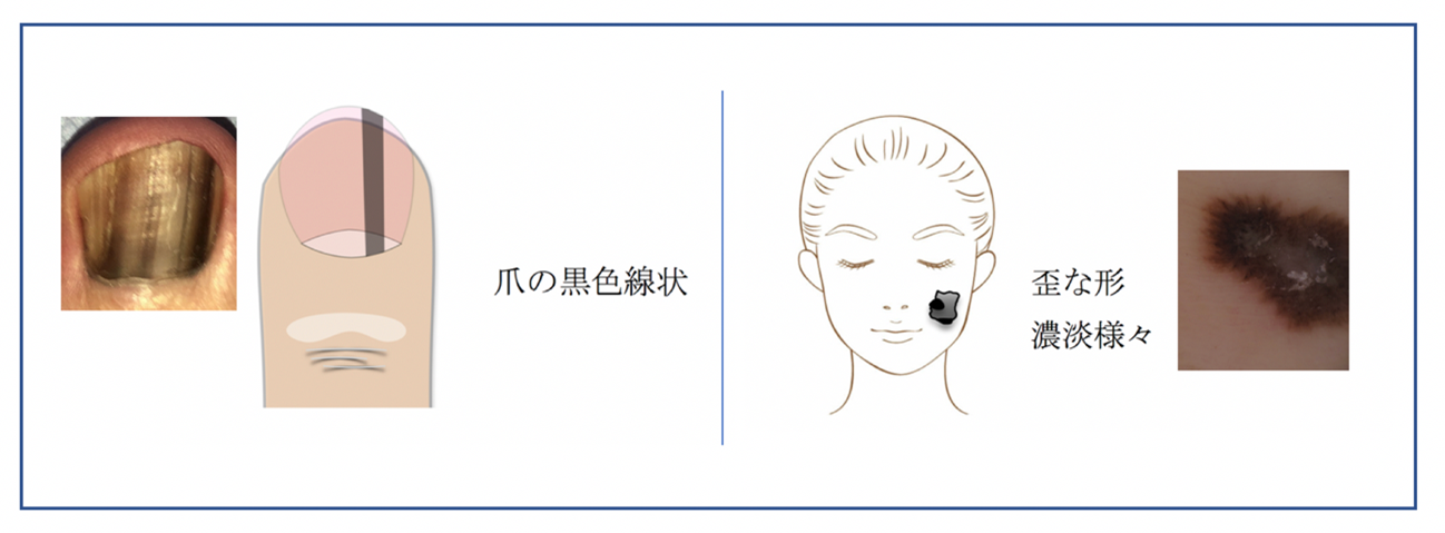 悪性黒色腫 悪性黒色腫