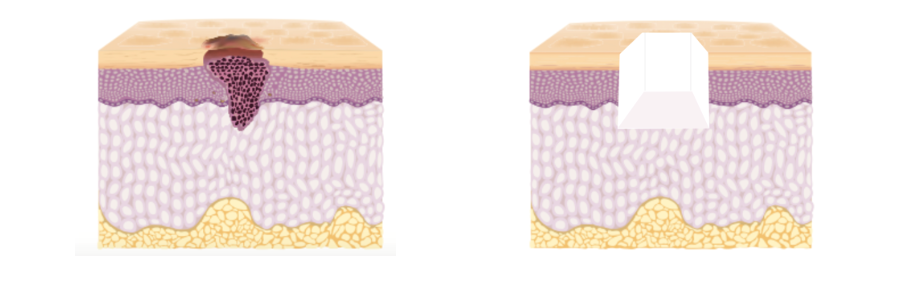 がんの切除 がんの切除