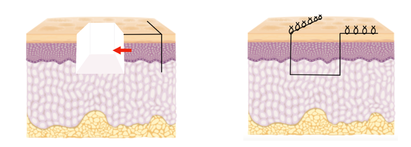 皮弁術質感 皮弁術質感