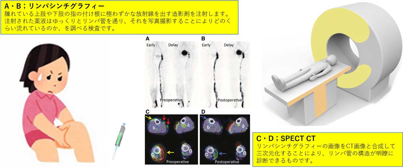 リンパ浮腫の検査