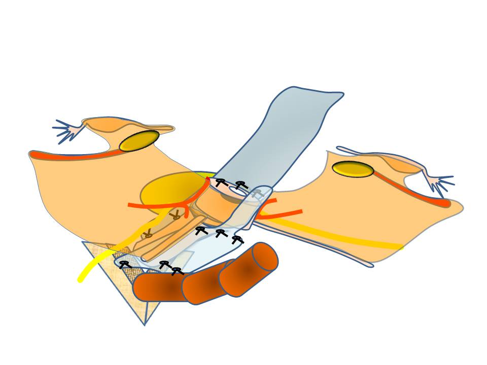 腹腔鏡下仙骨腟固定術 腹腔鏡下仙骨腟固定術