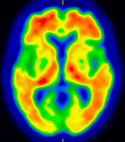 アルツハイマー型認知症のアミロイドPET