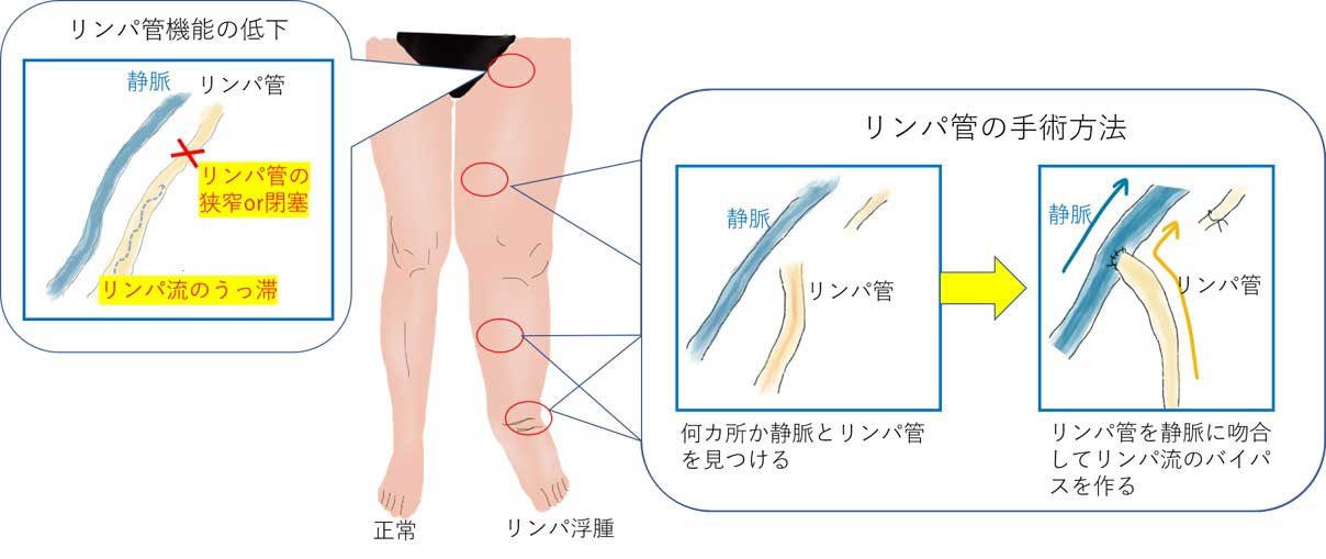 リンパ浮腫手術は何科？