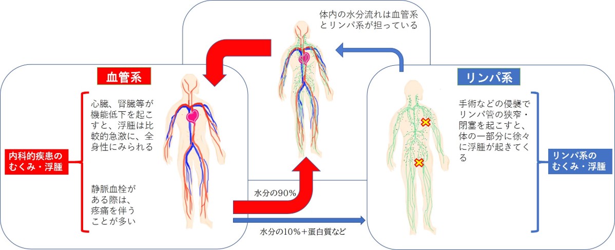 リンパ浮腫と原因