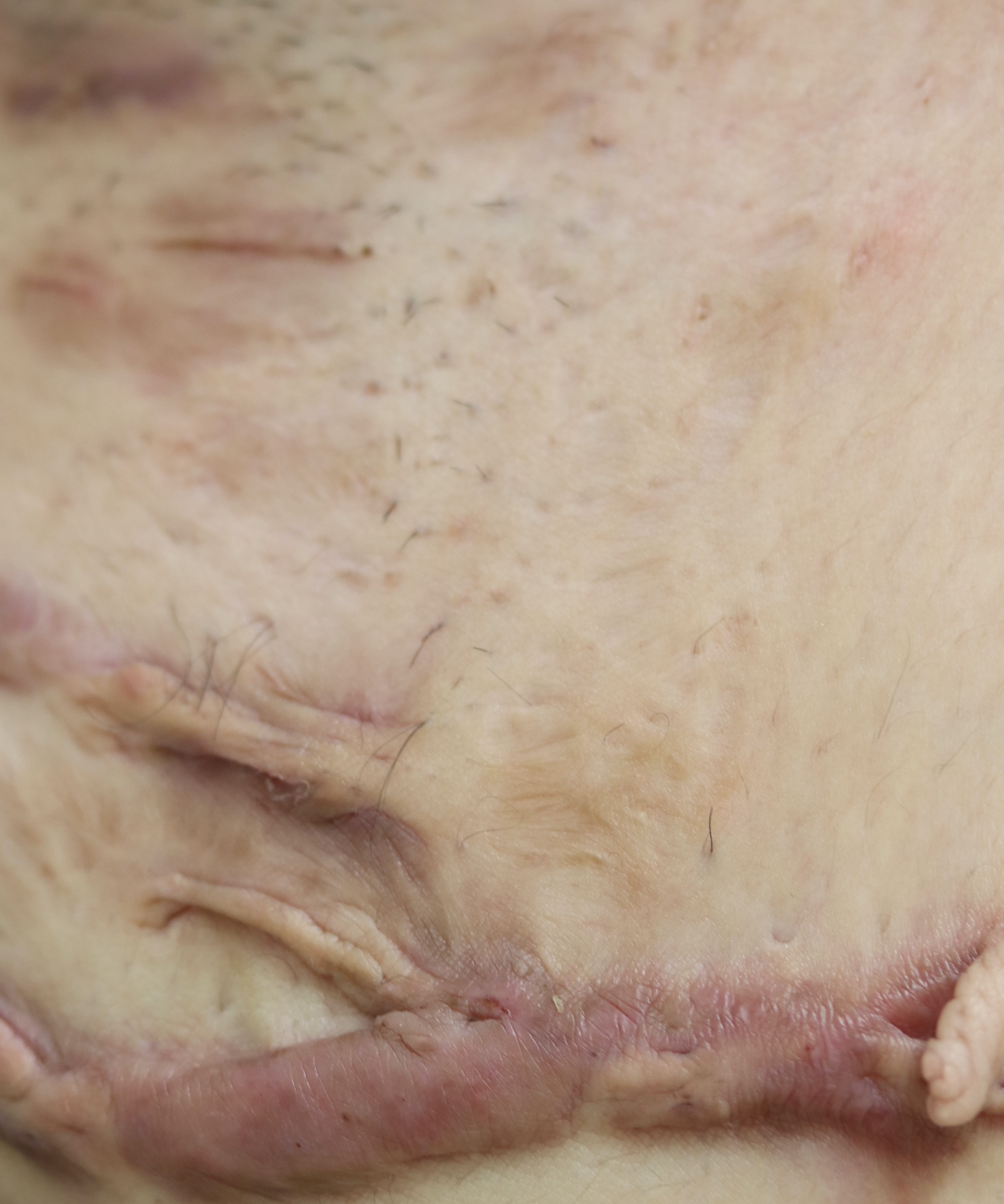 化膿性汗腺炎11584-23082833-20230913 (2)のコピー